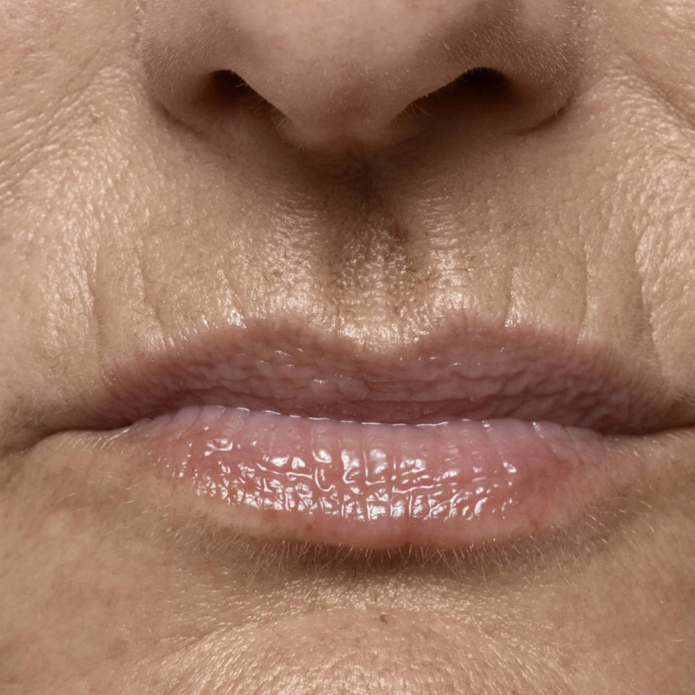 Lip lines