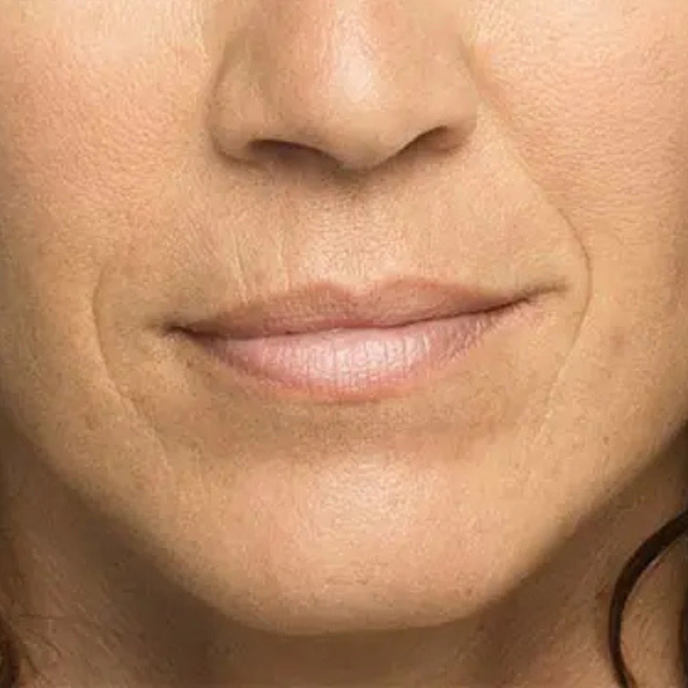 Smile lines